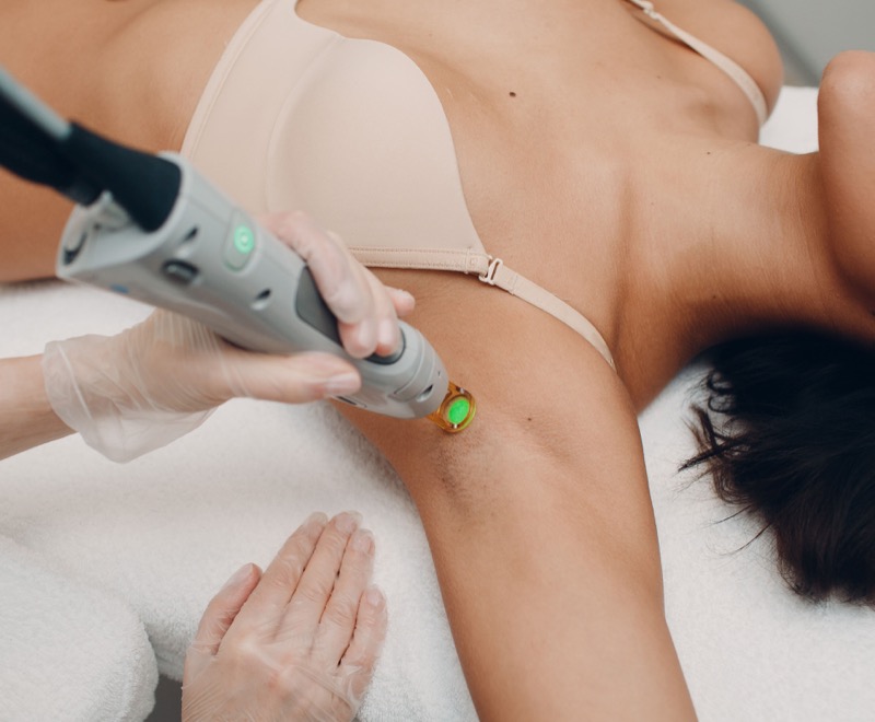 Laser Hair Removal